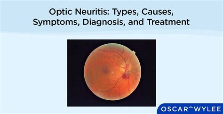 Can an eye doctor see optic neuritis?
