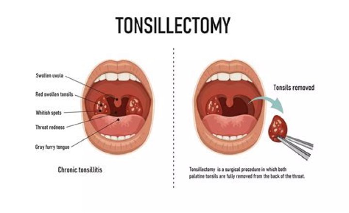 What is the benefit of removing tonsils?