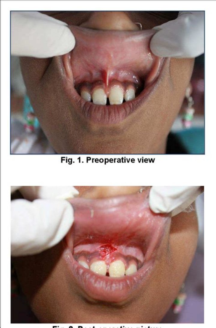 Will a frenectomy close a gap?